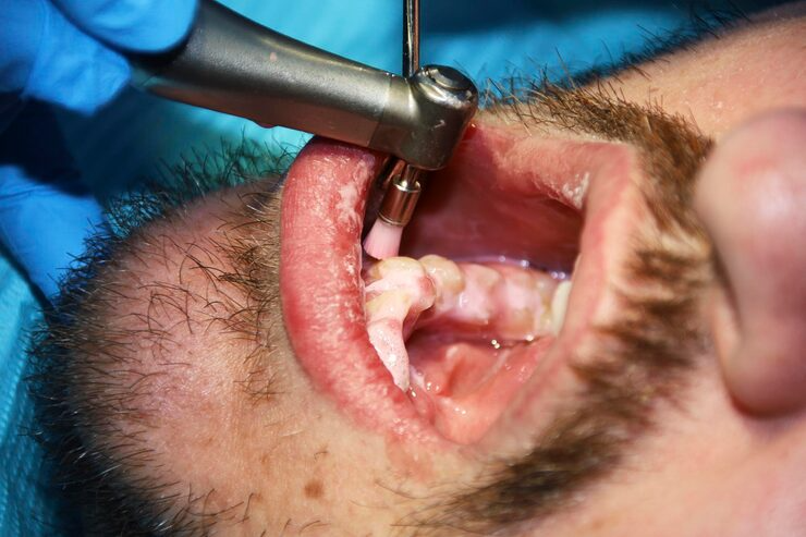 202507301429044397961_dental_implant3