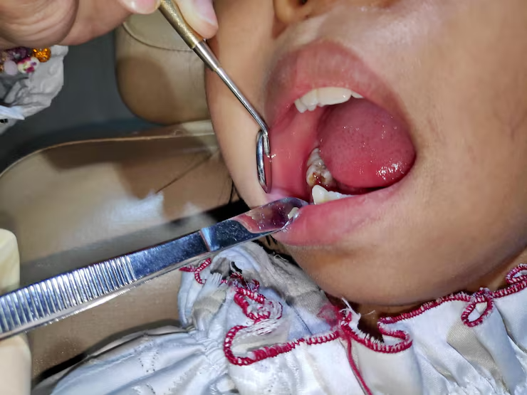 202507301429306169453_dental_implant3